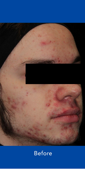 AviClear Before & After Patient #1668